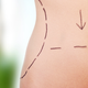 Illustration for article titled Gold Nanoparticles Are Coming To Melt Your Fat for Liposuction